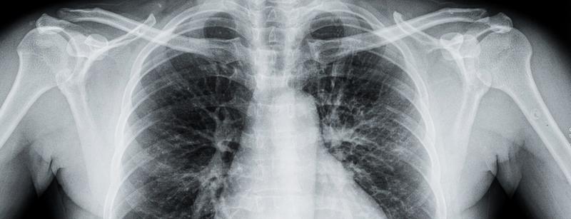 Грипп А субтипа H3N2 — как определить и защититься