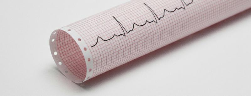 Инфаркт миокарда