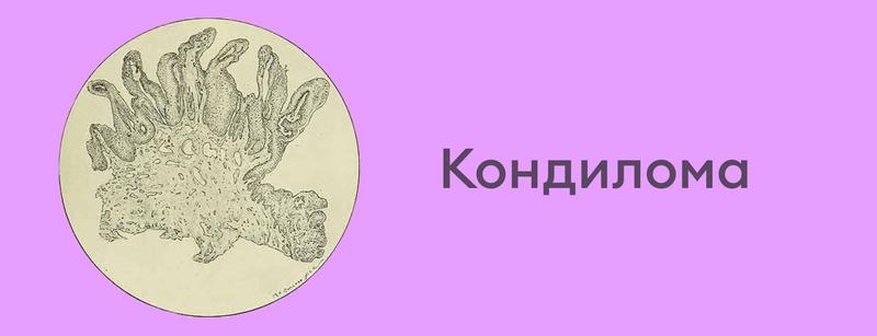 Осложнения интимных кондилом