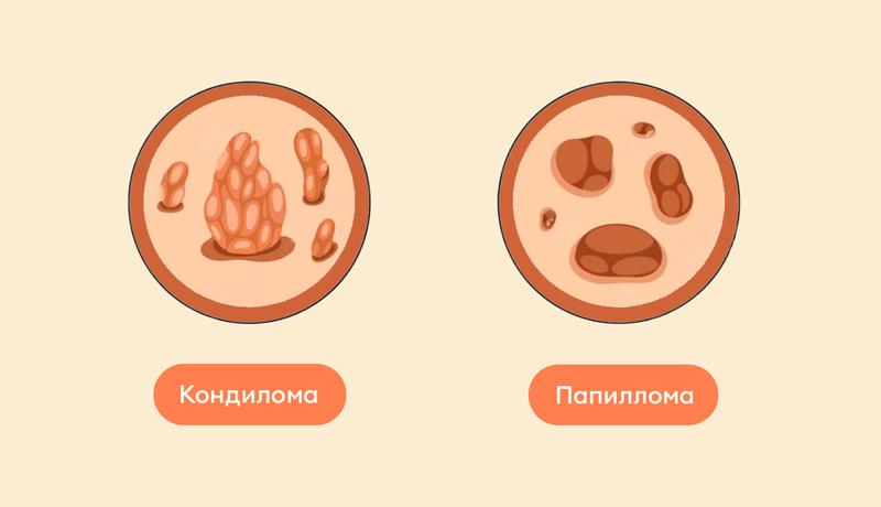 Как выглядит кондилома