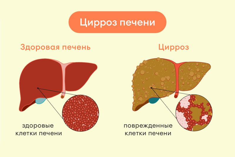 Какая печень при циррозе