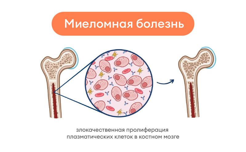 Миеломная болезнь - причины