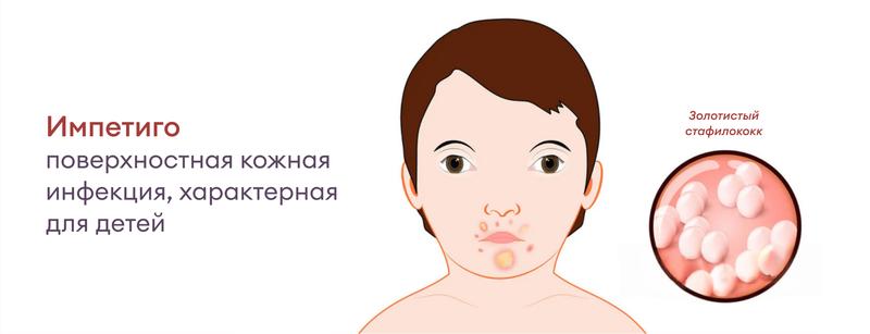 Стафилококк в мазке – причины и лечение